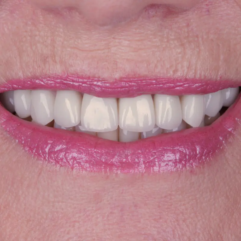 Resultado de facetas em resina na clínica odontológica Novident em Caxias do Sul e Bom Princípio