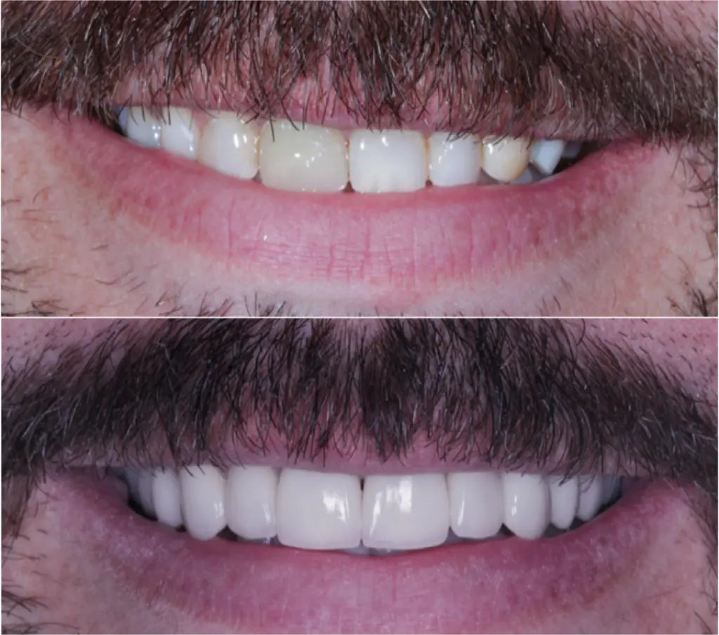 Página Inicial 8 Antes e depois do tratamento odontológico "faceta de resina" realizada pelos dentistas da clínica odontológica Novident em Caxias do Sul e Bom Princípio