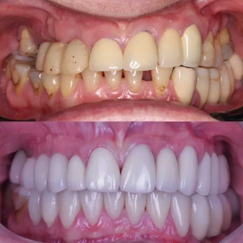 Página Inicial 10 Antes e depois do tratamento odontológico "implante dentário" realizada pelos dentistas da clínica odontológica Novident em Caxias do Sul e Bom Princípio