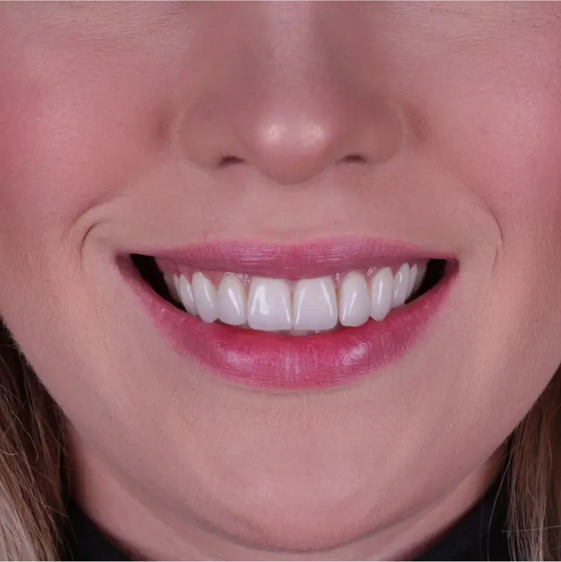 Resultado de lentes de contato dental na clínica odontológica Novident em Caxias do Sul e Bom Princípio