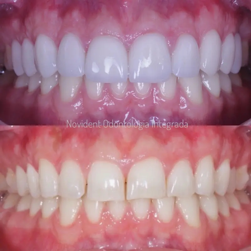 Página Inicial 7 Antes e depois do tratamento odontológico "lente de contato dental" realizada pelos dentistas da clínica odontológica Novident em Caxias do Sul e Bom Princípio