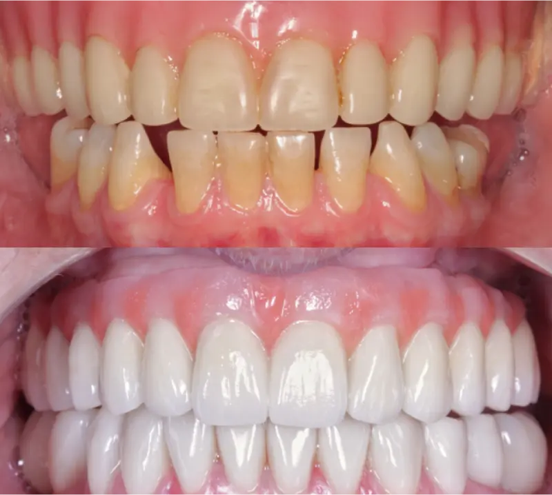 Página Inicial 9 Antes e depois de protocolo dentário na clínica odontológica Novident em Caxias do Sul e Bom Princípio