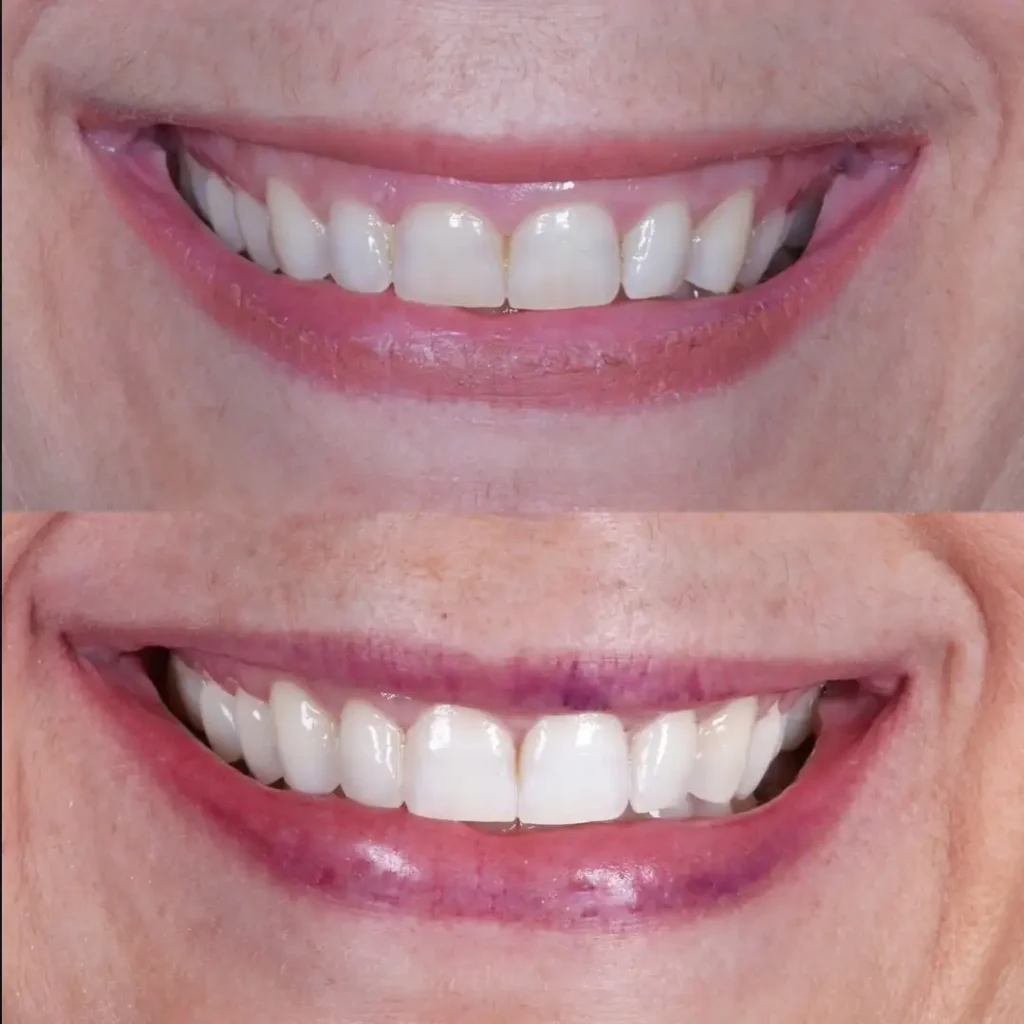 Deise Gengivoplastia