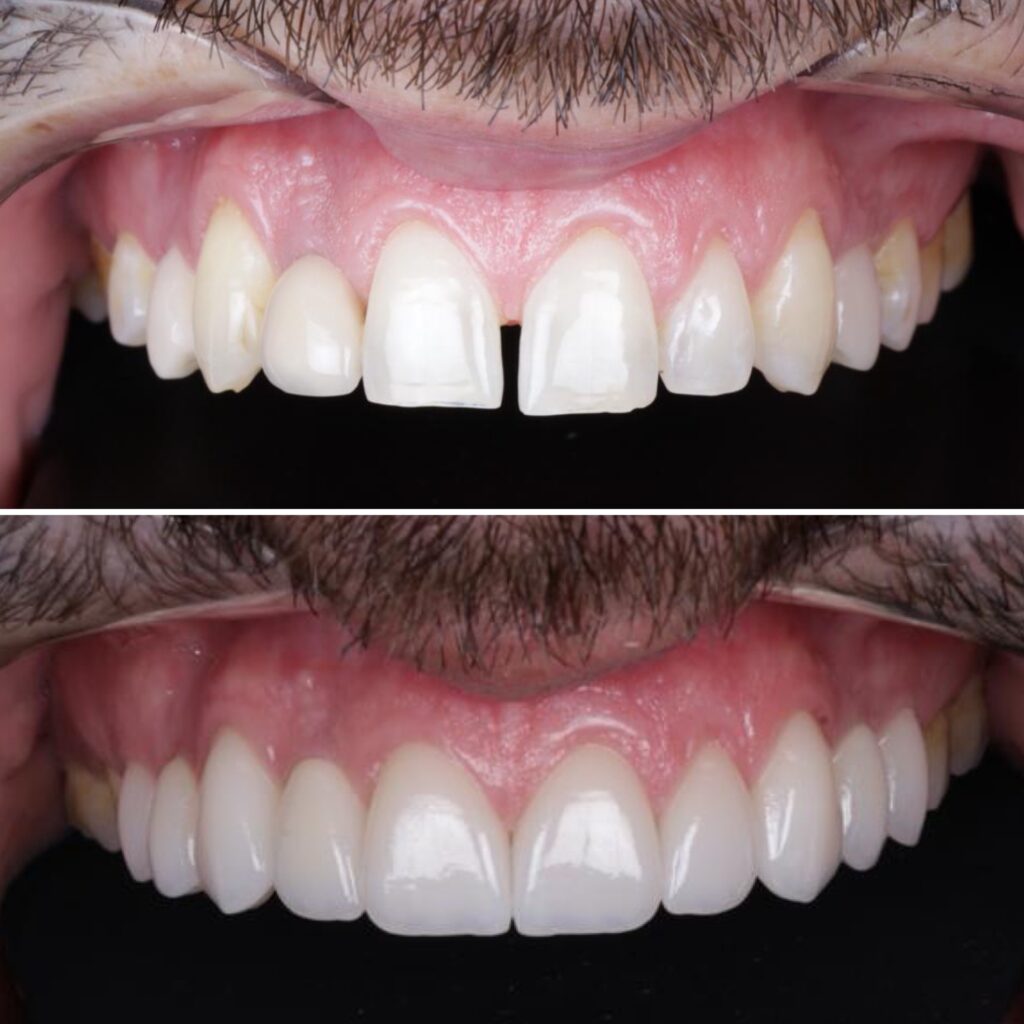 Antes e Depois Facetas