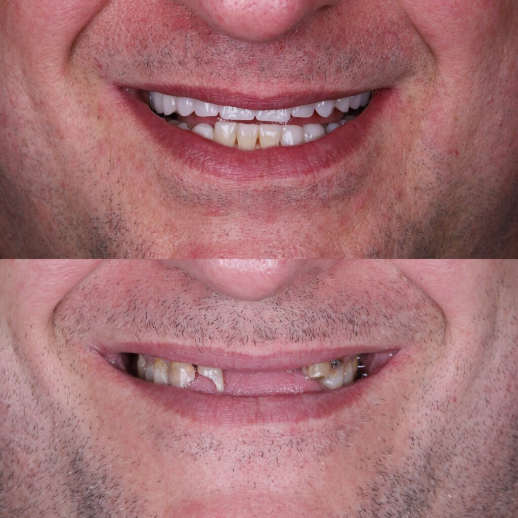 Antes e Depois Protocolo 1