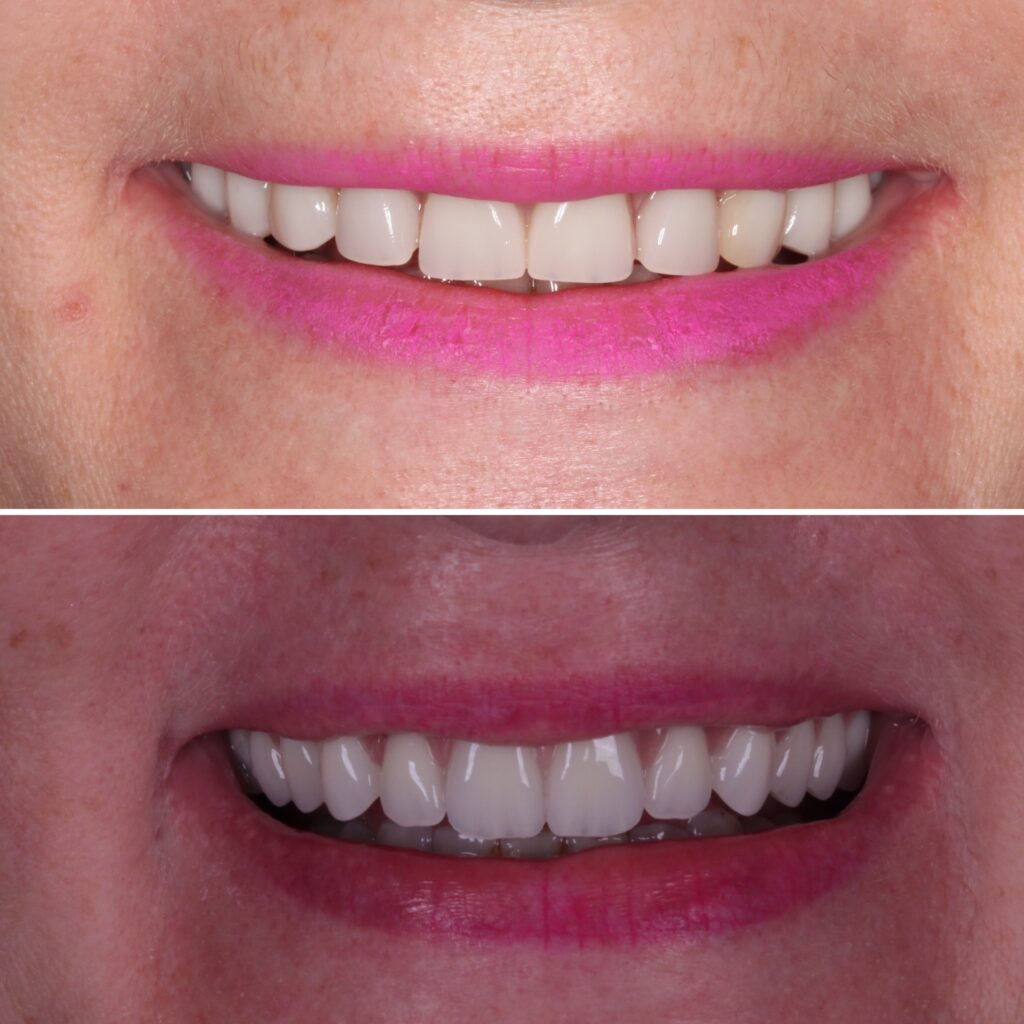 Antes e Depois Protocolo