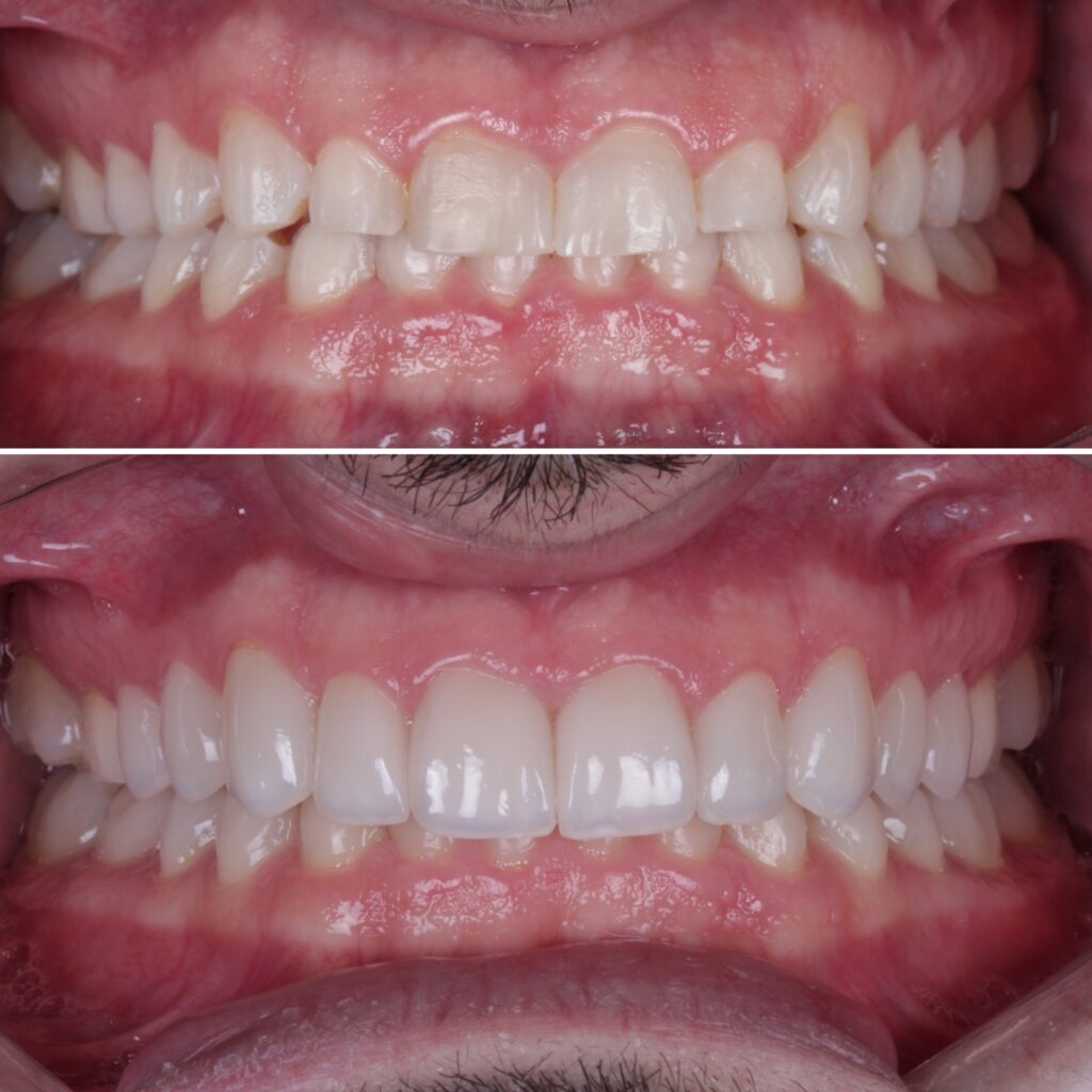 Antes e Depois laminado ceramico