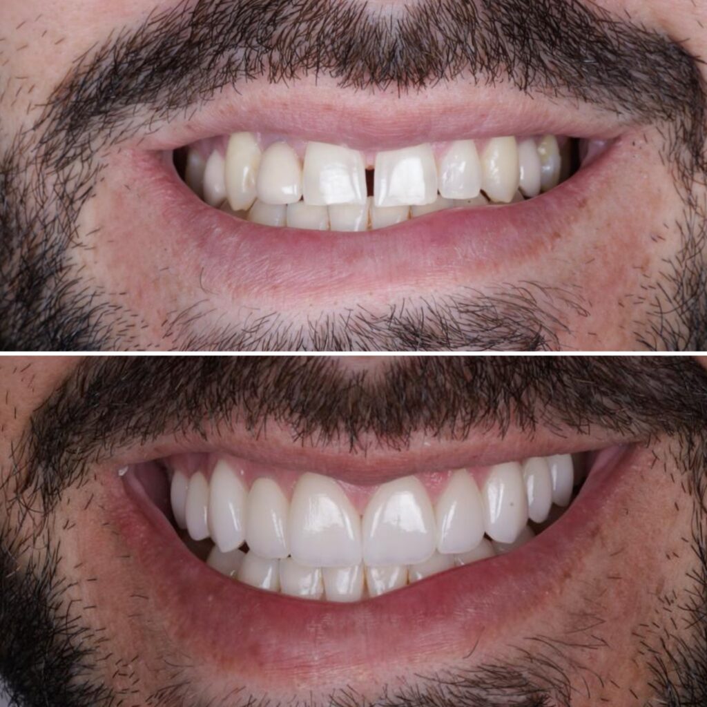 antes e depois lente de contato dental 1
