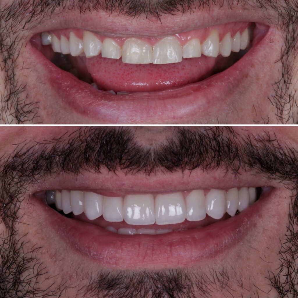antes e depois lente de contato dental
