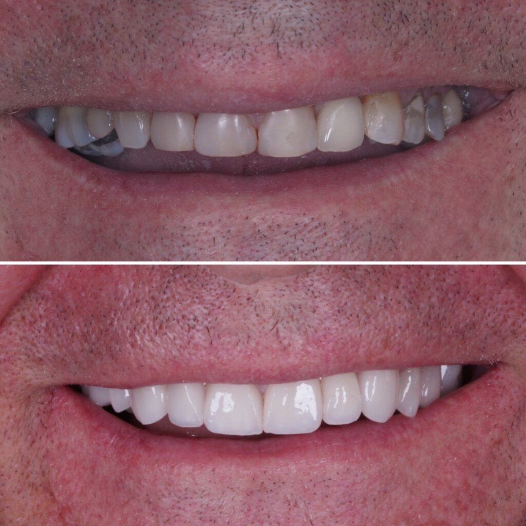 antes e depois lente de contato dental 2