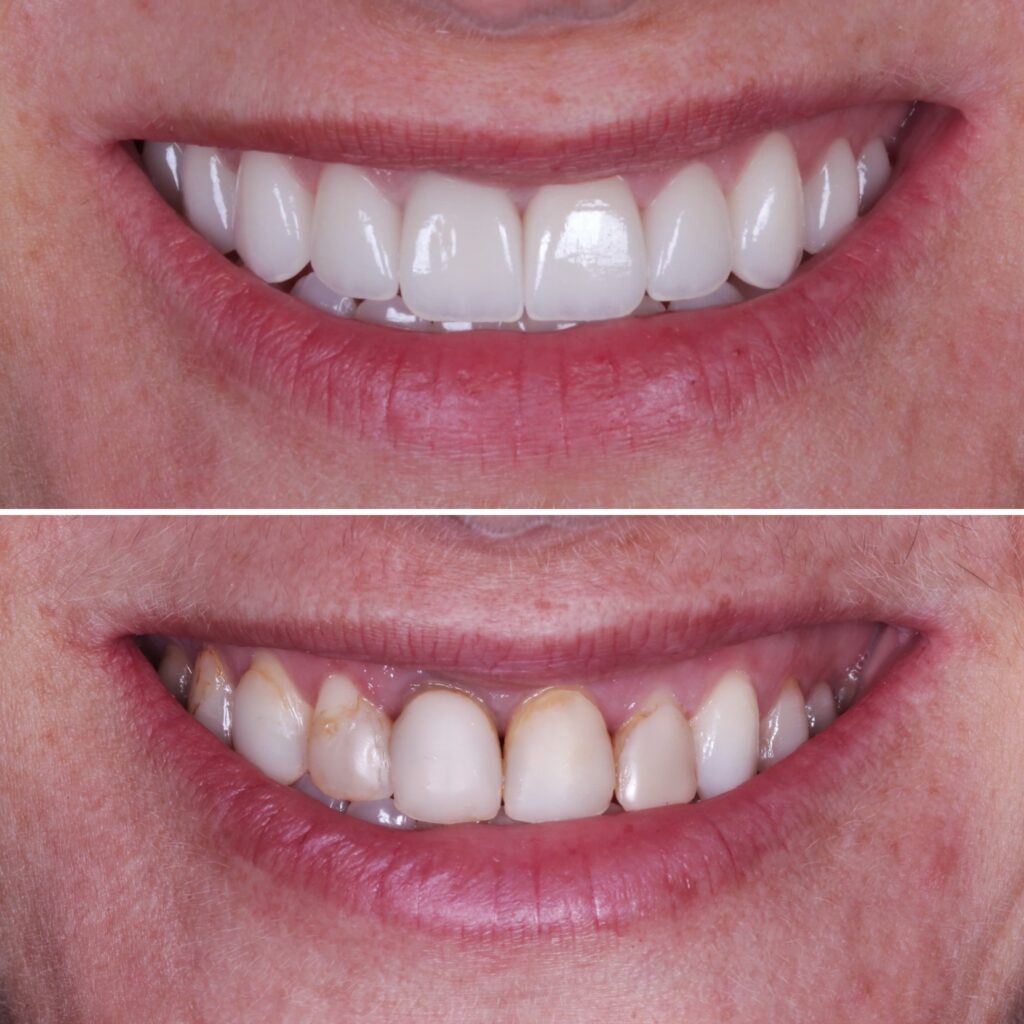 antes e depois lentes de contato dental ceramico