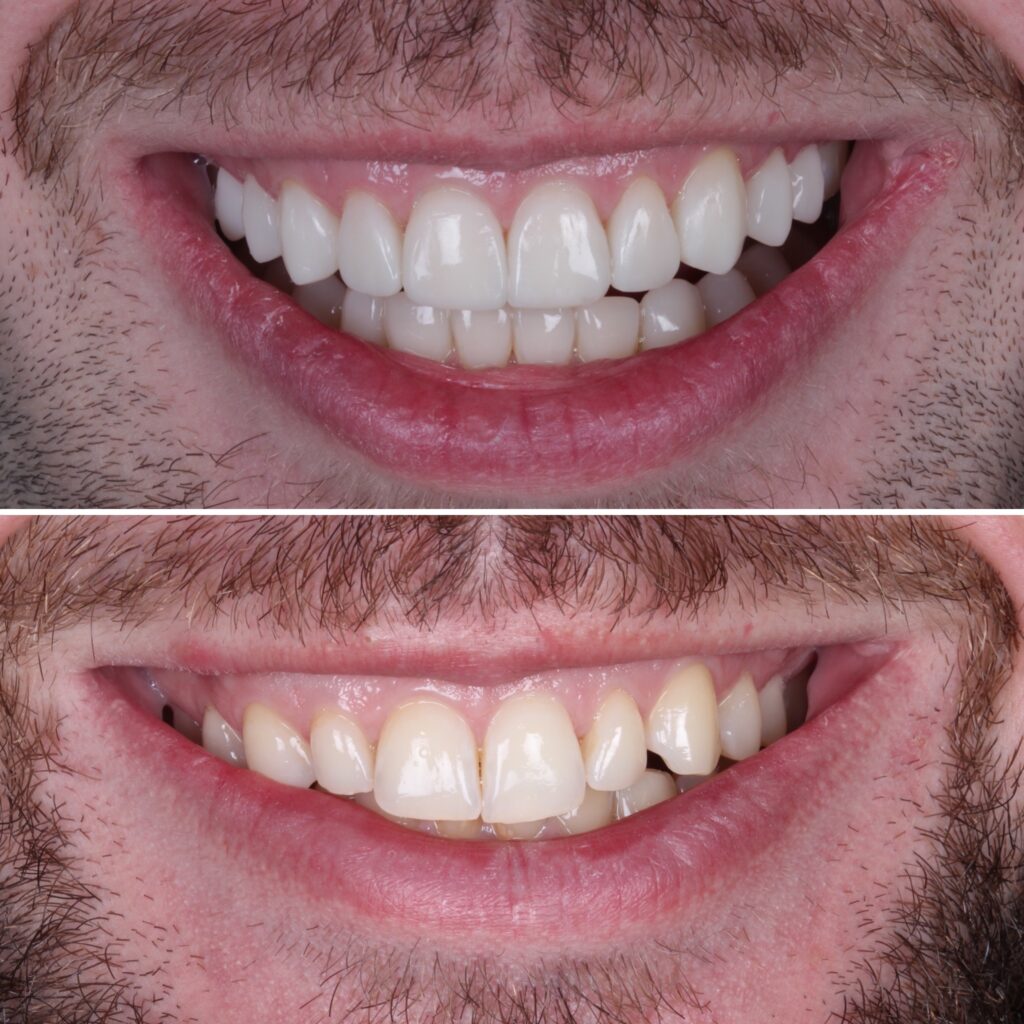 antes e depois resina composta