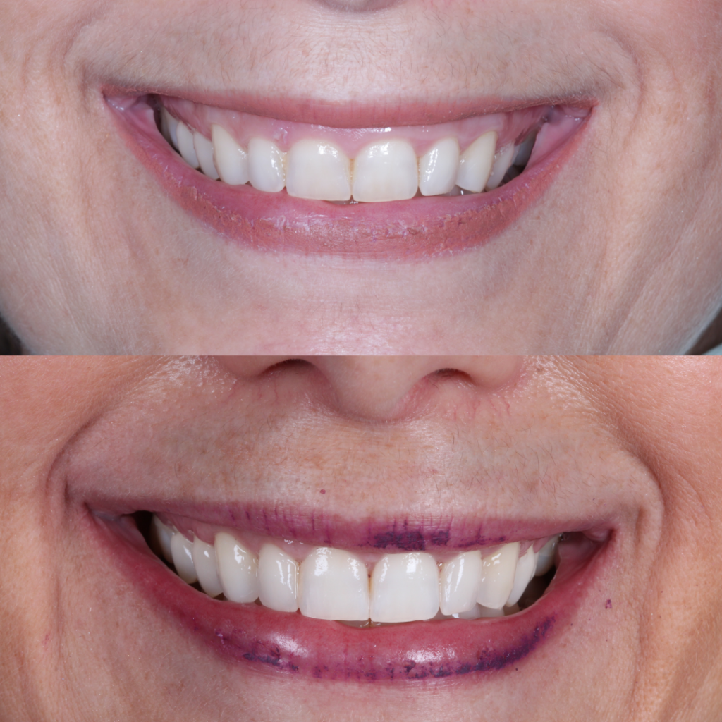 GENGIVOPLASTIA3