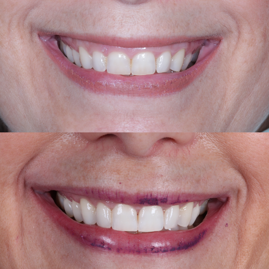 Página Inicial 16 GENGIVOPLASTIA3